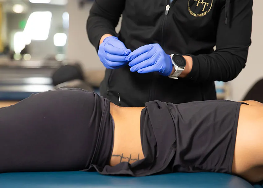 Dry needling session in the Dickson Physical Therapy clinic