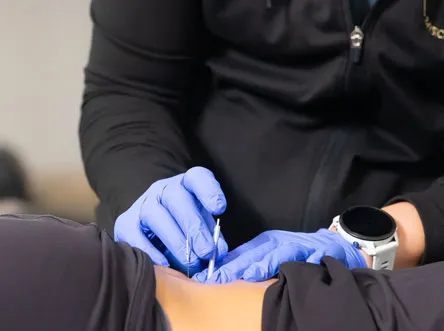 Physical therapist performing dry needling on a patient’s low back